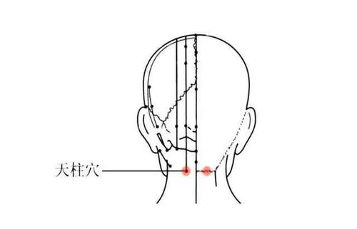 偏头痛之艾灸疗法 