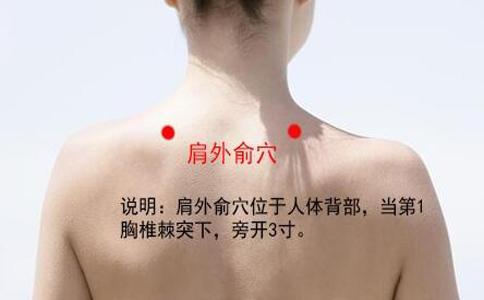 气滞血瘀型颈椎病之拔罐疗法