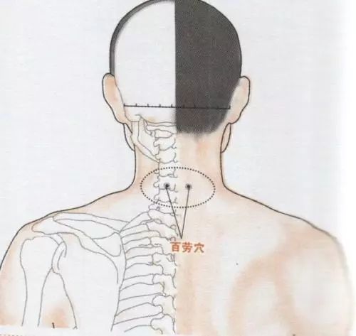 气滞血瘀型颈椎病之拔罐疗法