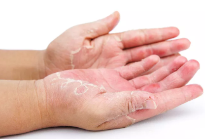 手癣早期症状图片图片