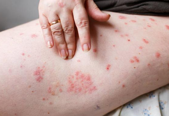 荨麻疹与湿疹之间怎么区分 