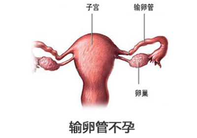 女性要提防输卵管炎易影响怀孕