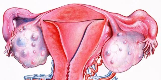 卵巢囊肿和卵巢肿瘤的区别