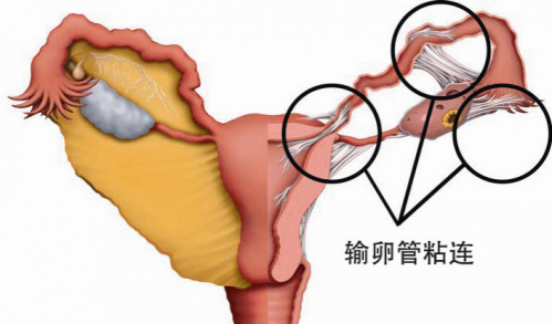 输卵管粘连怎么治？