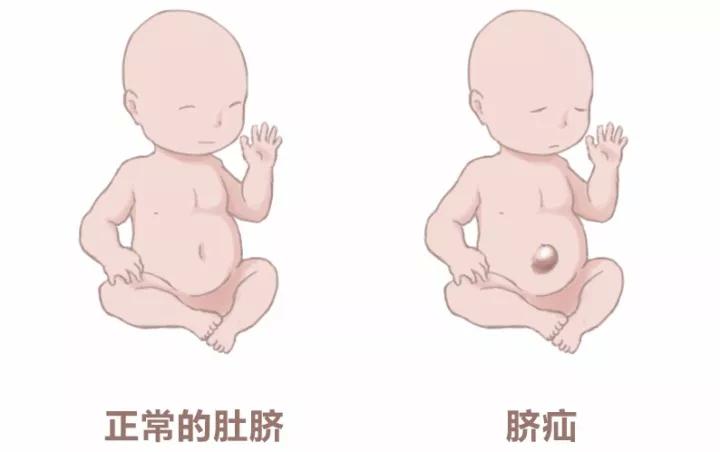 宝宝脐疝图片 症状图片