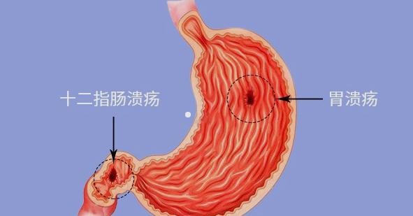 胃溃疡位置图片图片