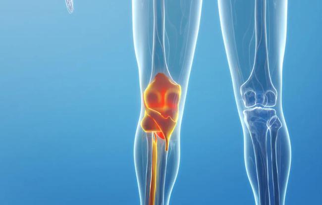 膝盖疼伸直痛的因素总结