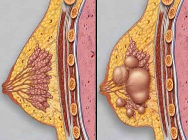 乳腺囊肿