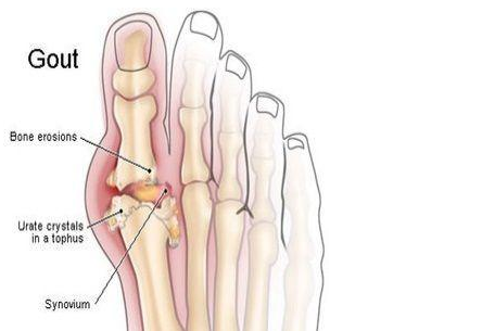 痛风性关节炎主在抗炎