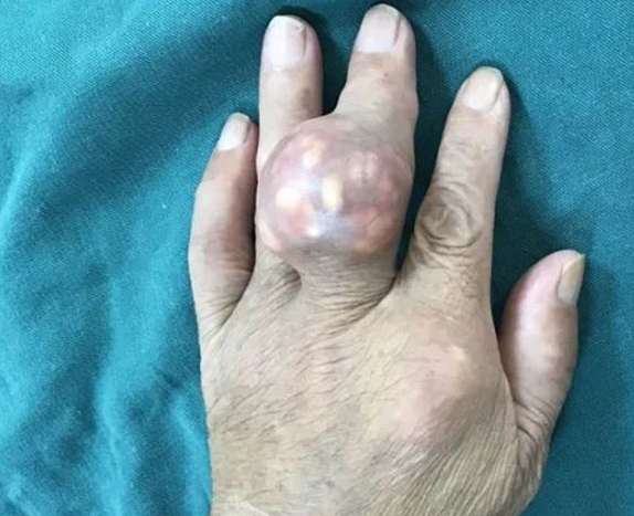 尿酸盐结晶
