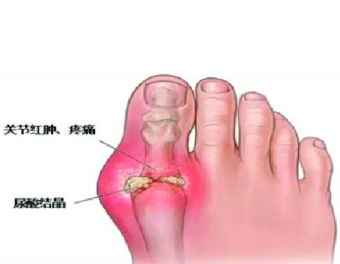 痛风石致关节变形