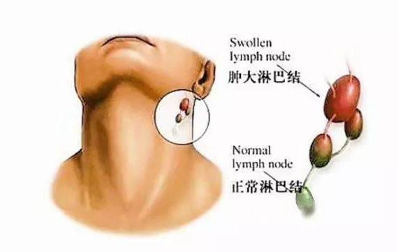 淋巴结的状态