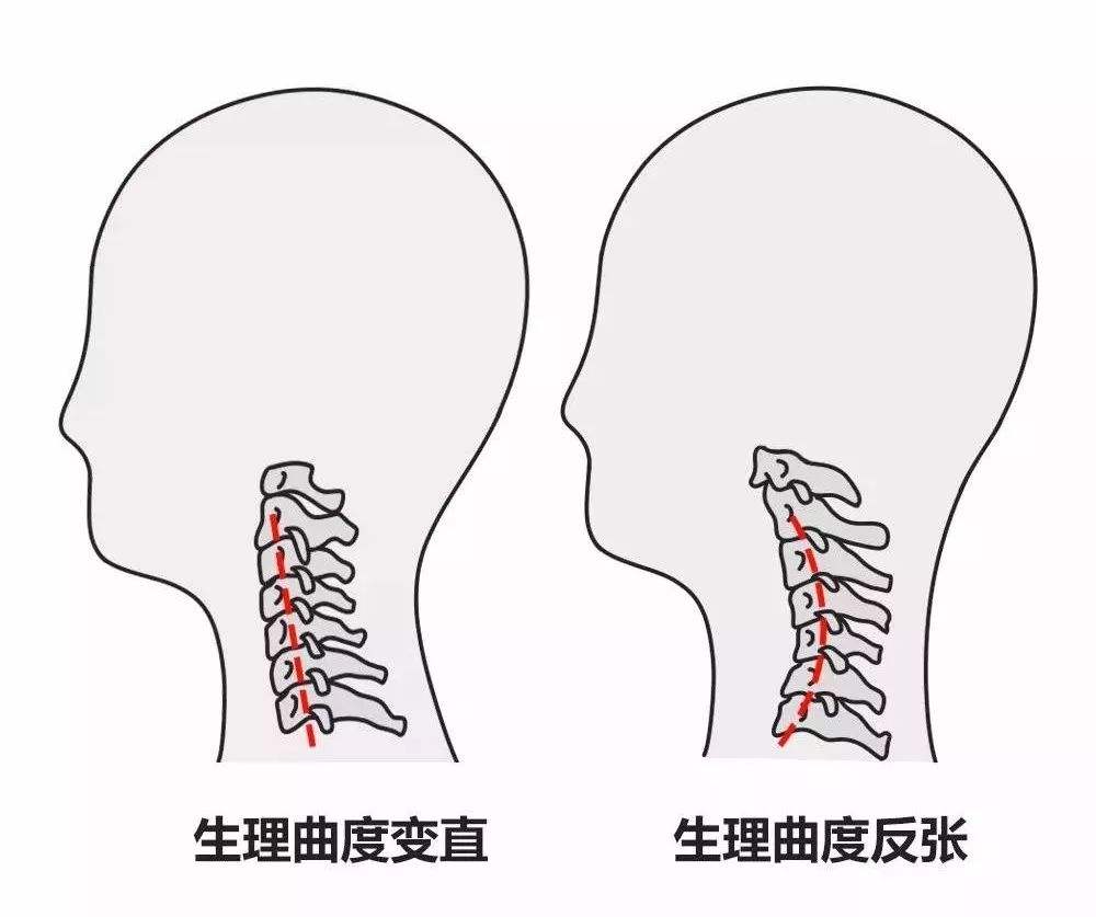 颈椎病