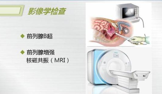 前列腺检查