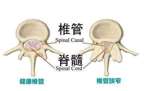 什么是腰椎管狭窄