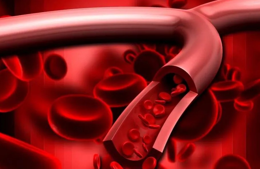 膀胱癌可能会导致血尿